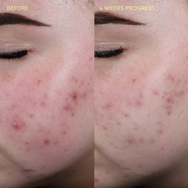 Blemish Relief Soothing Mist Facial Toner | Bruma Facial